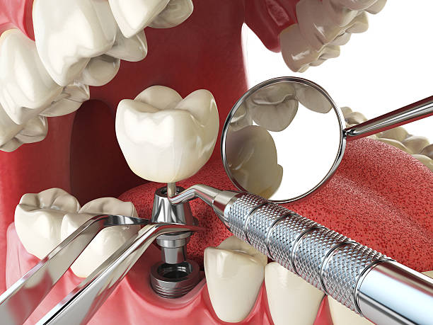 Best Emergency Broken Tooth Repair in Fellsmere, FL